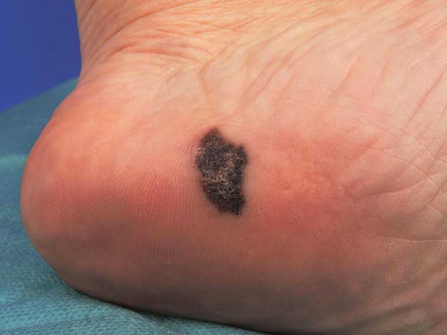 Is Acral Lentiginous Melanoma The Most Deadly Subtype Australian