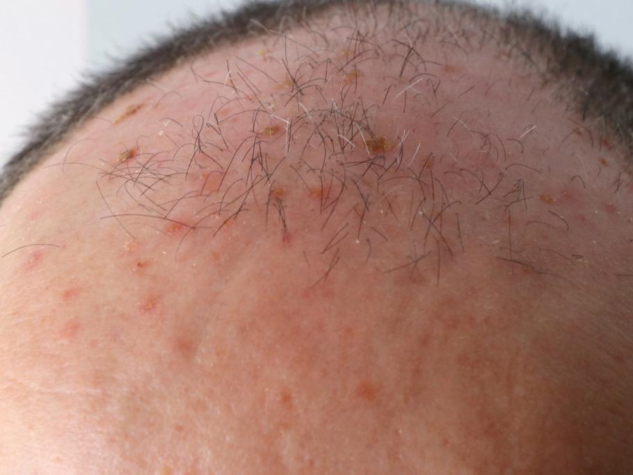 man's scalp with actinic keratoses