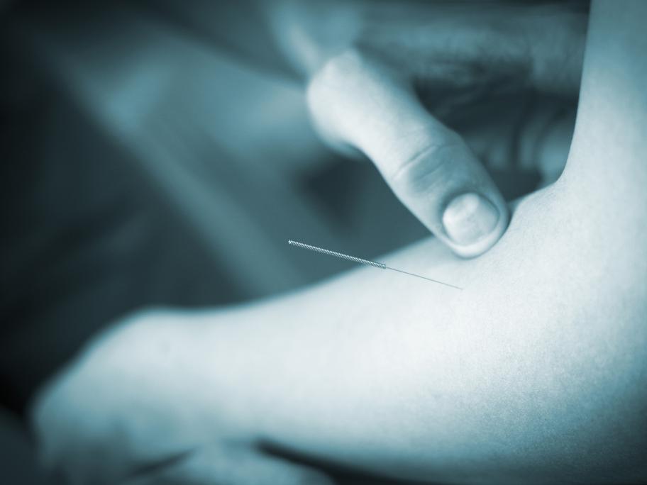 Acupuncture