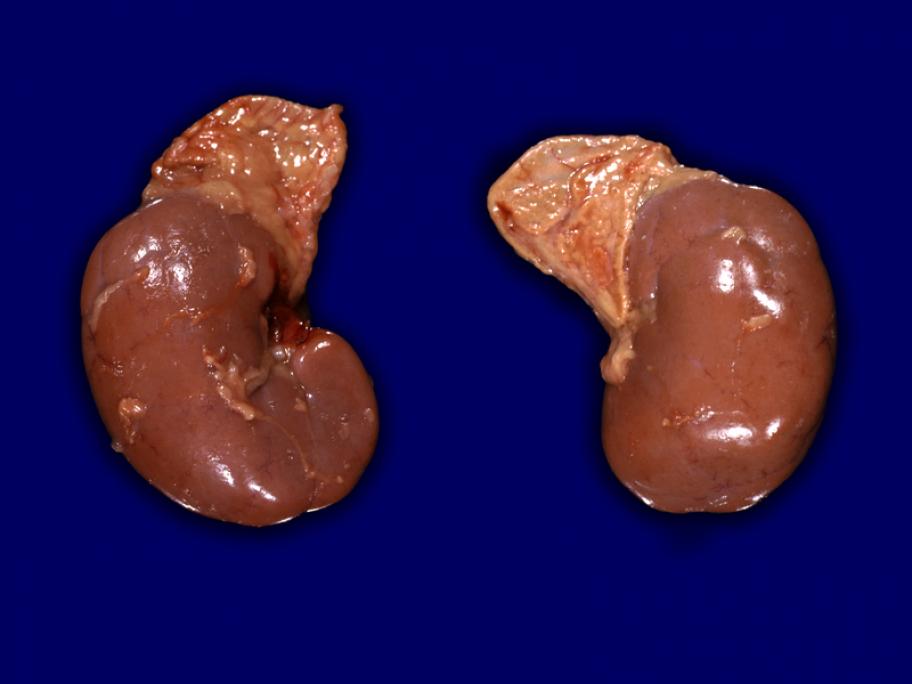 growth on adrenal gland on kidney