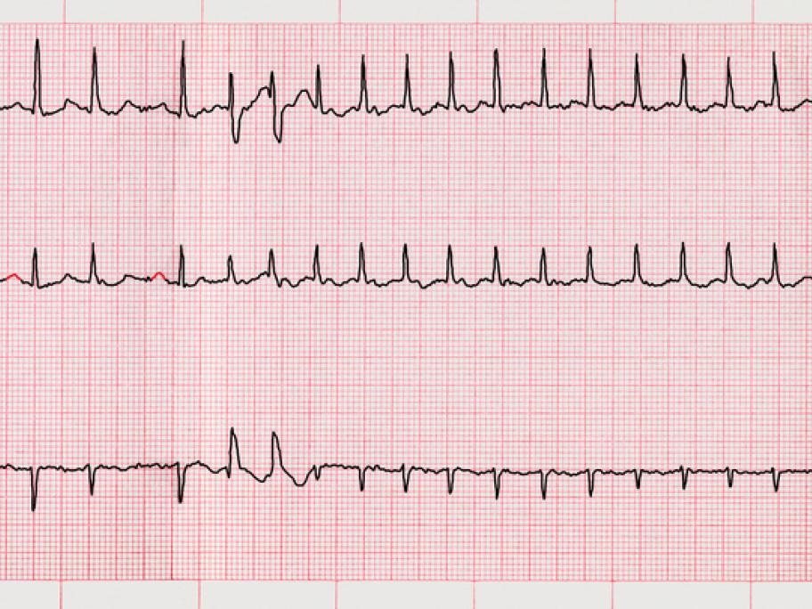 ECG showing AF