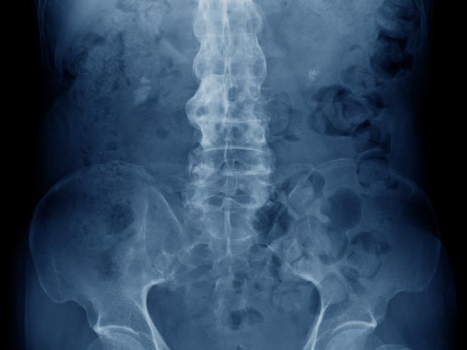 Anklyosing spondylitis X-ray of spine