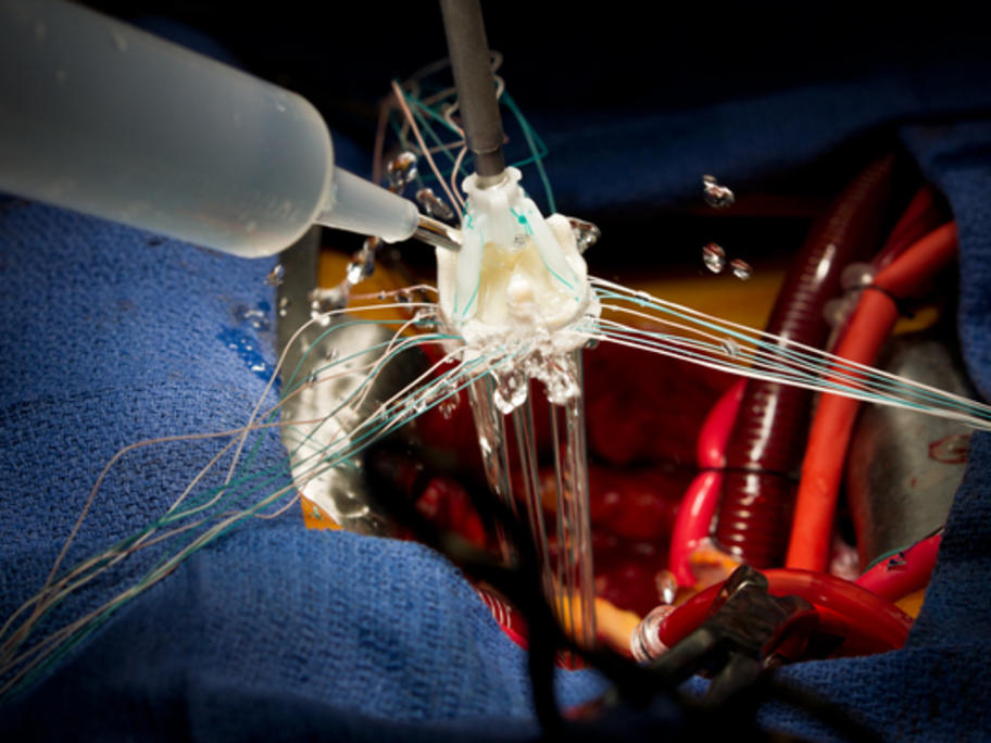 aortic valve replacement surgery
