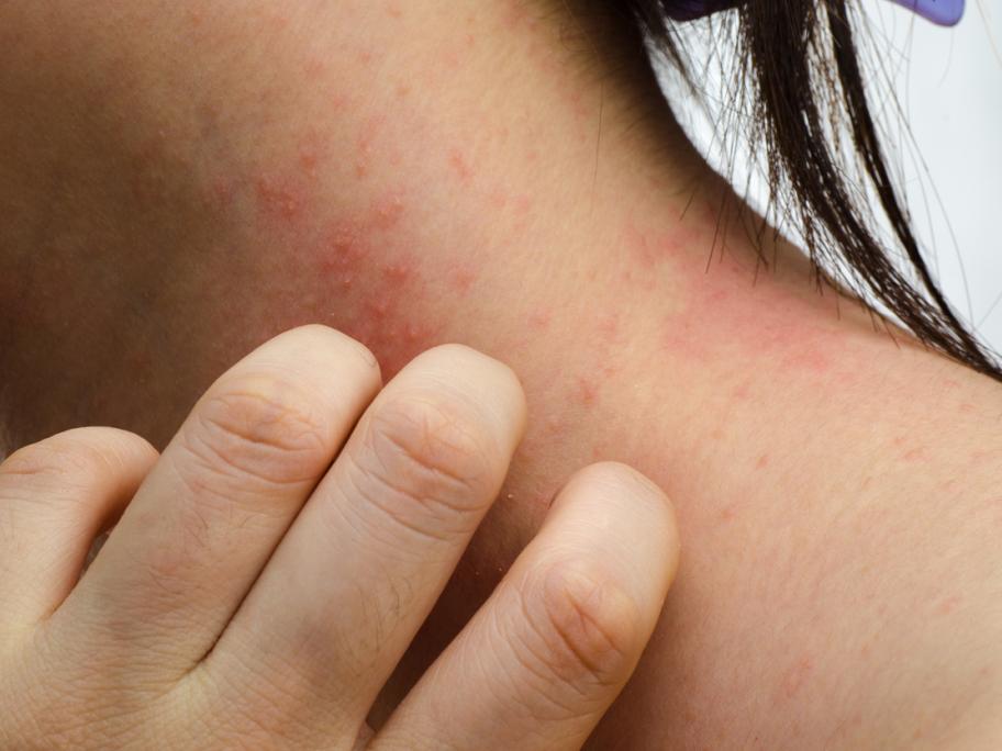 woman scratching rash on her neck