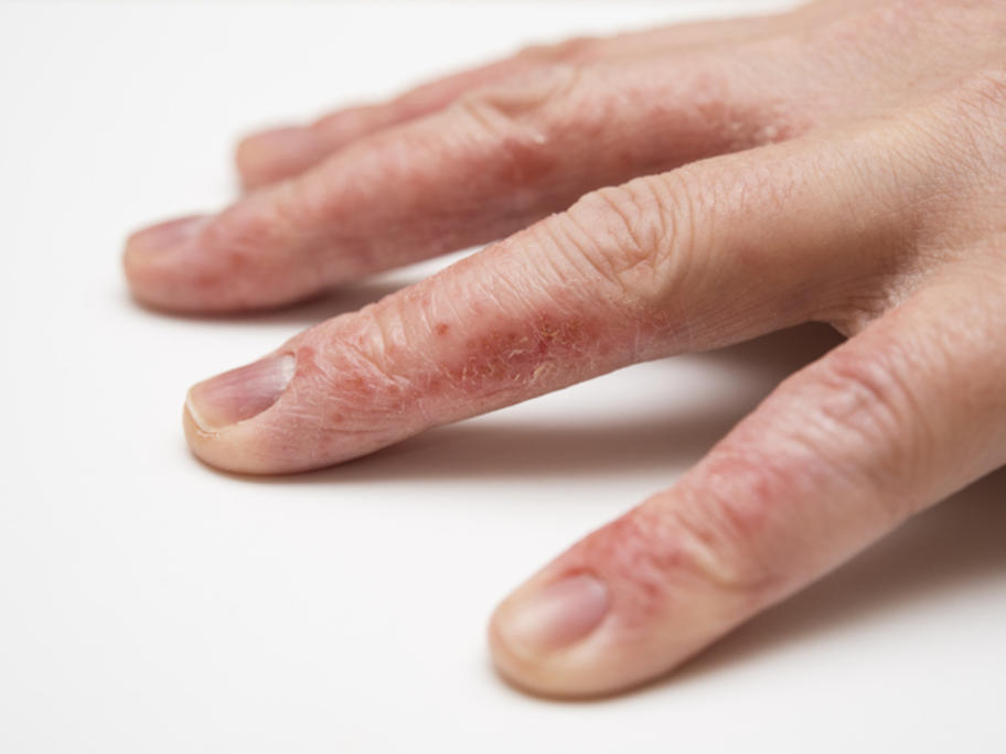 atopic dermatitis on the fingers