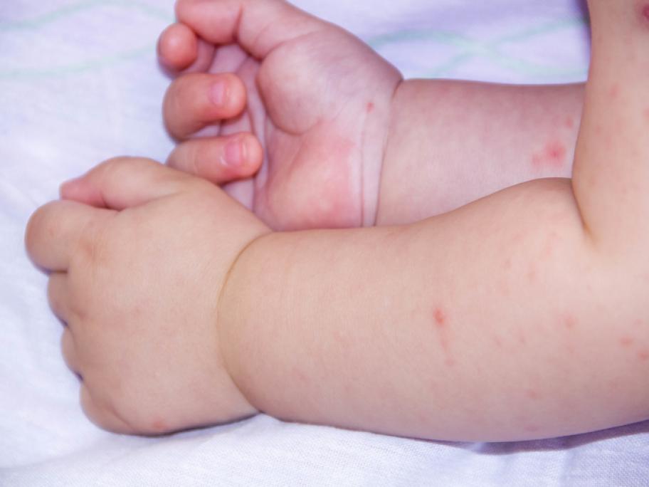 baby's arms with atopic dermatitis