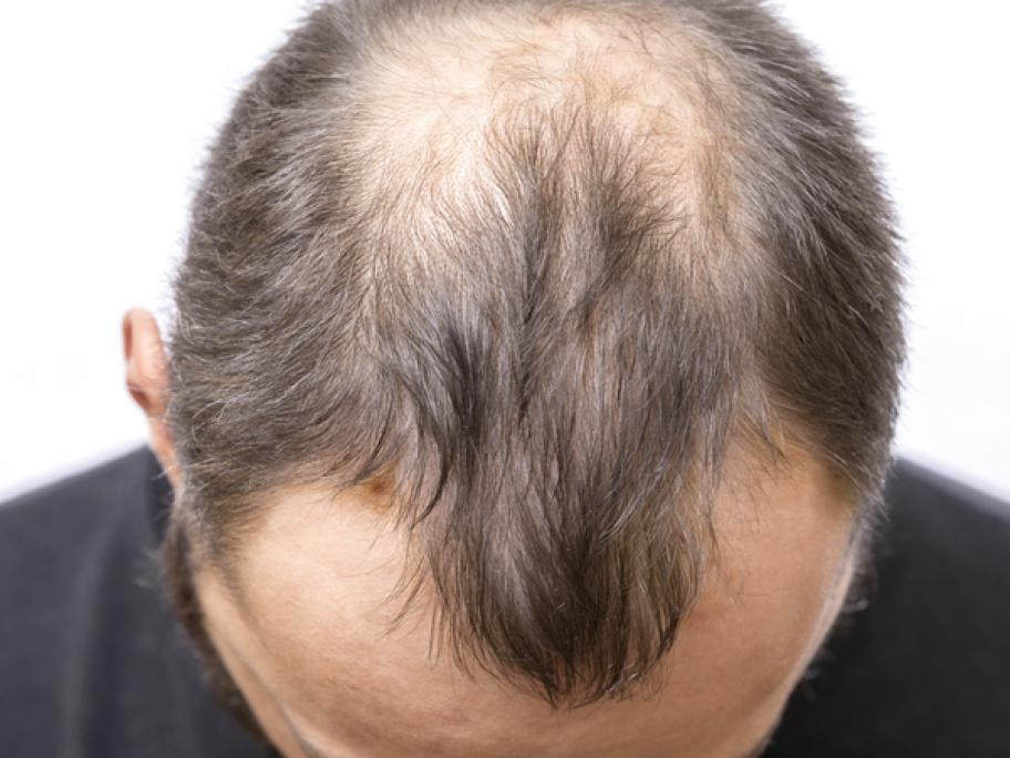 baldness