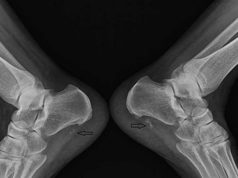 Non-union of the bilateral broken calcaneal spur