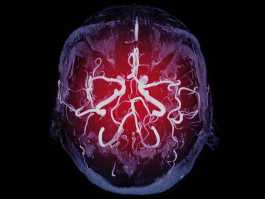 Brain image showing blood vessels