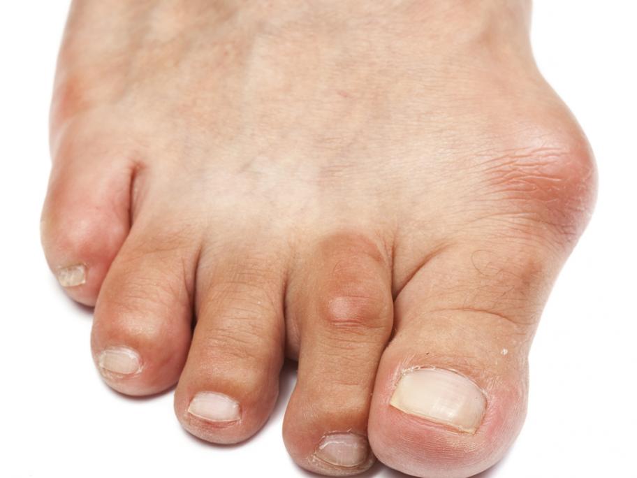 Bunion