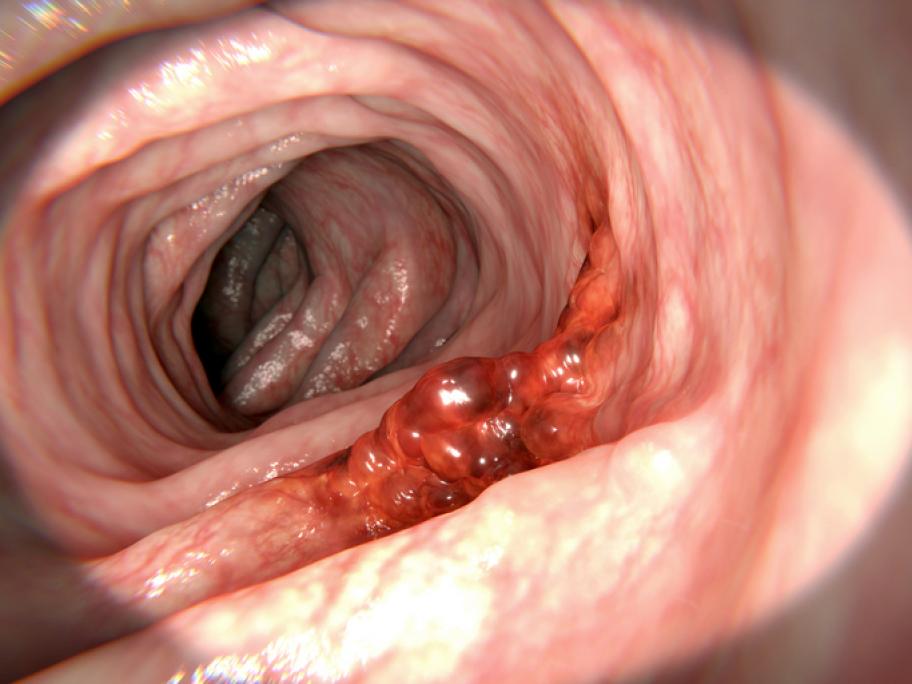 Colorectal cancer