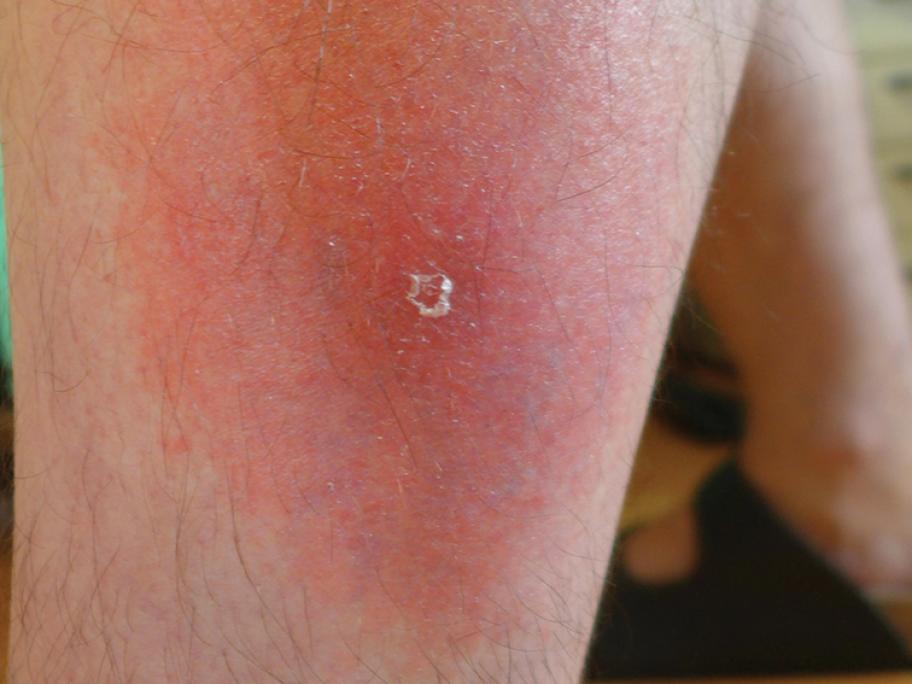 Lyme disease
