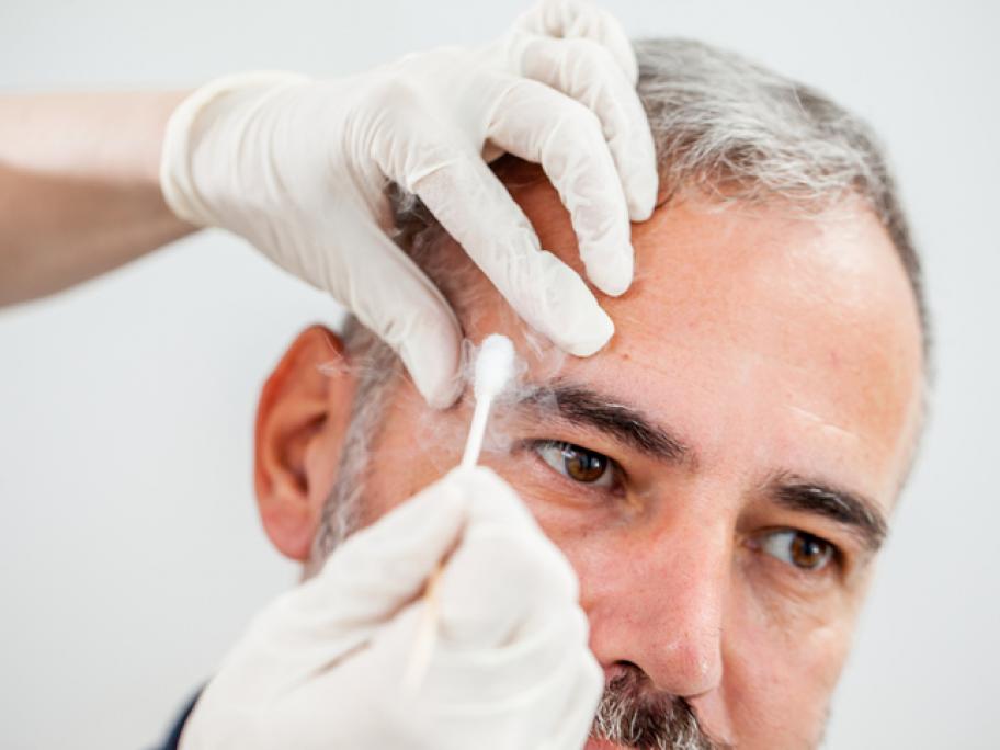 Cryotherapy on face