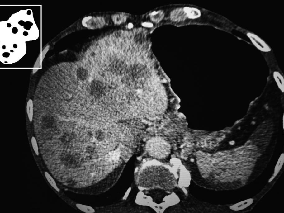 CT scan liver cancer