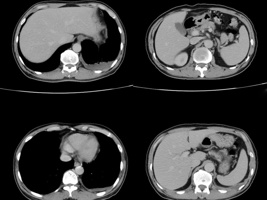 Lung cancer CT
