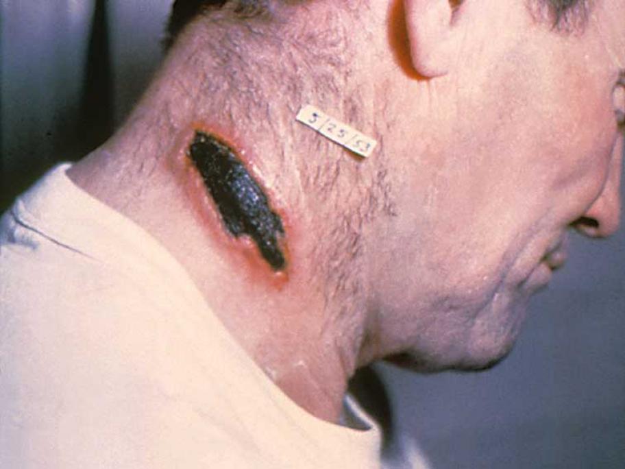 anthrax lesion