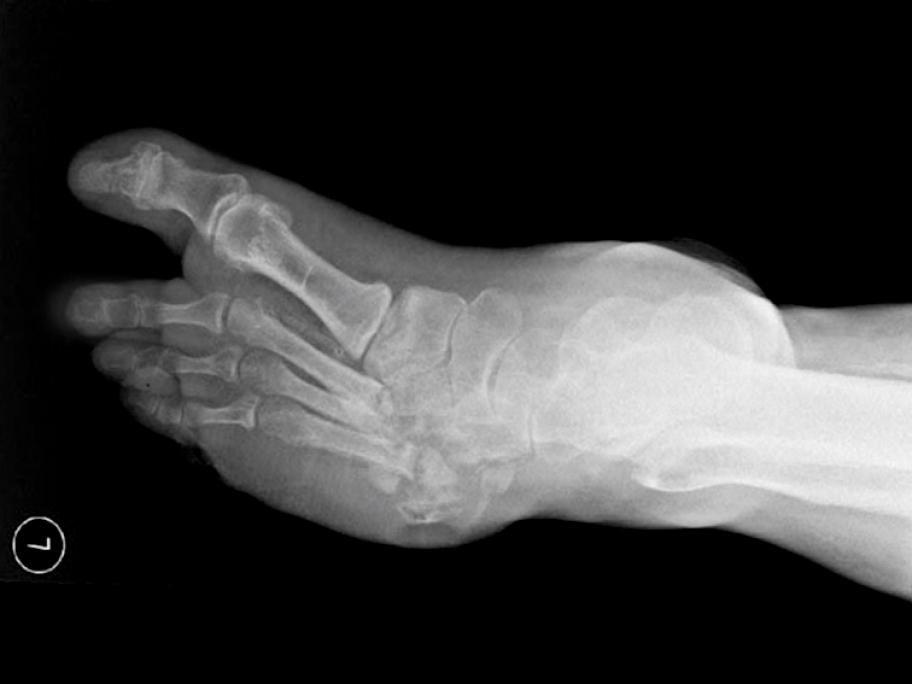 Diabetes foot BMJ