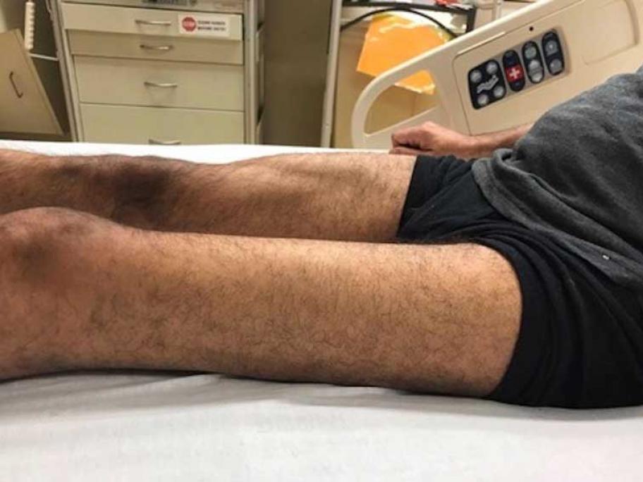 Diabetic amyotrophy