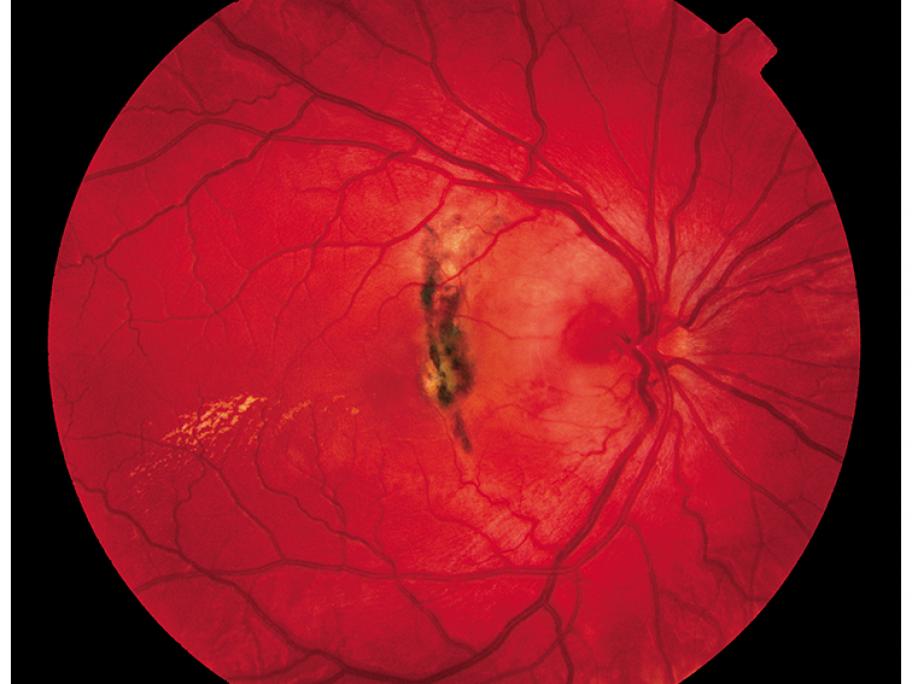 diabetic retinopathy