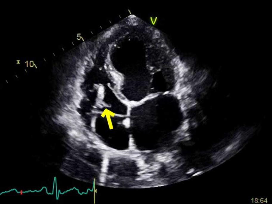 Transthoracic echocardiogram