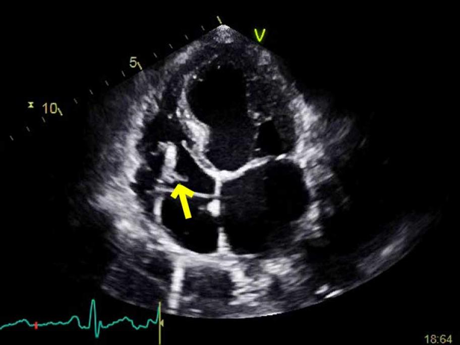 Puppy scratch leads to unique case of infective endocarditis ...