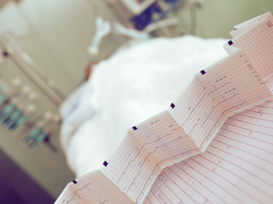 ECG