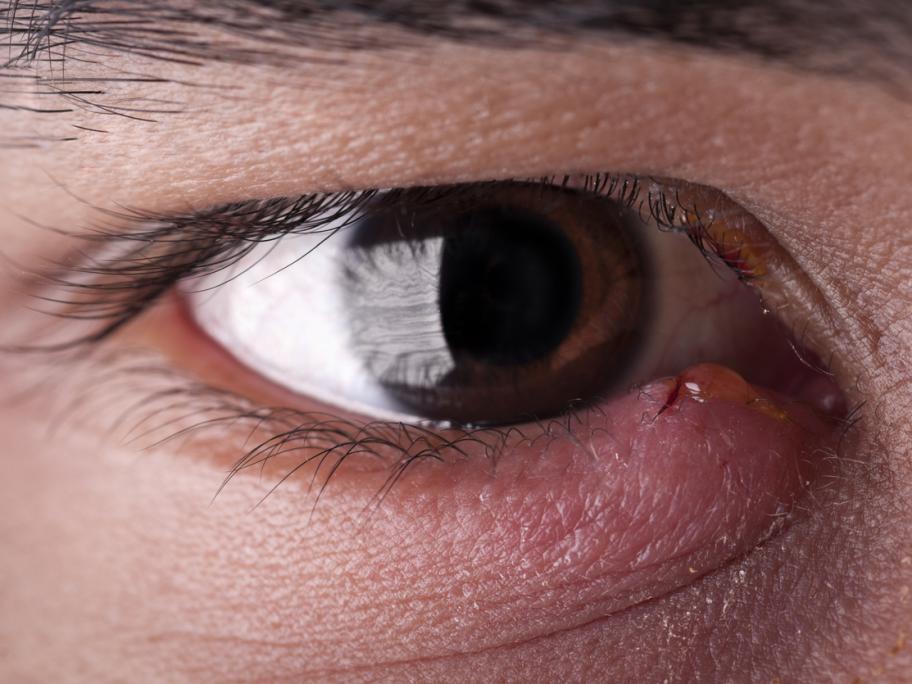 Eye