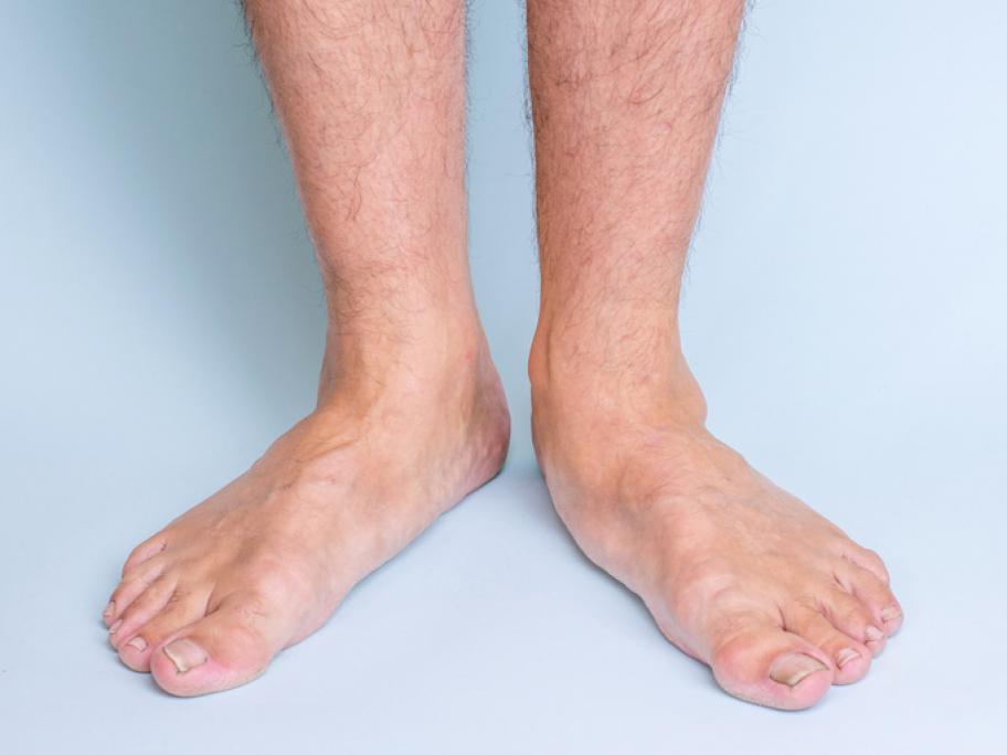 Foot orthotics