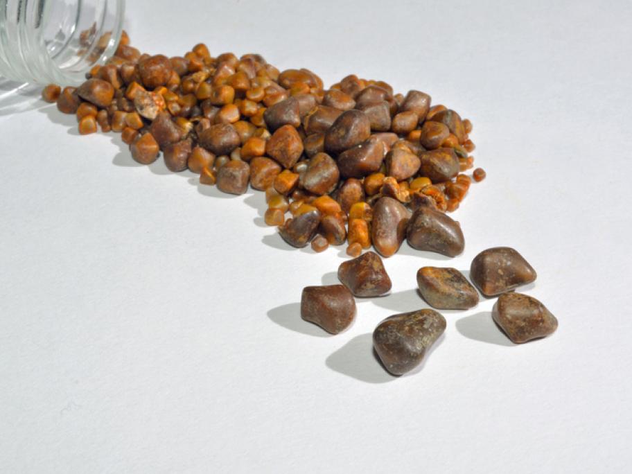 gallstones
