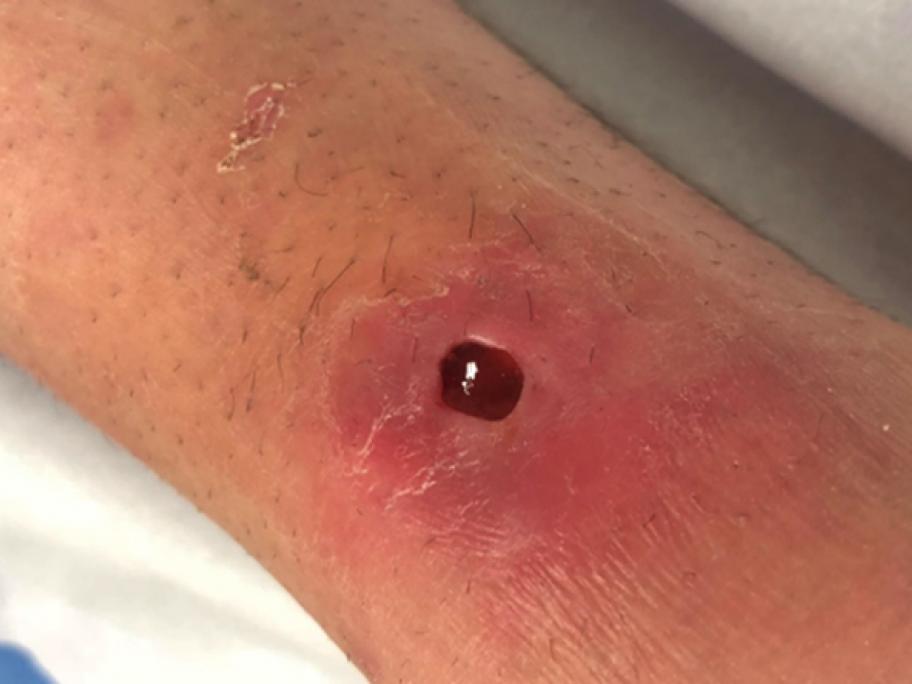 Fig 1_ulcer at presentation