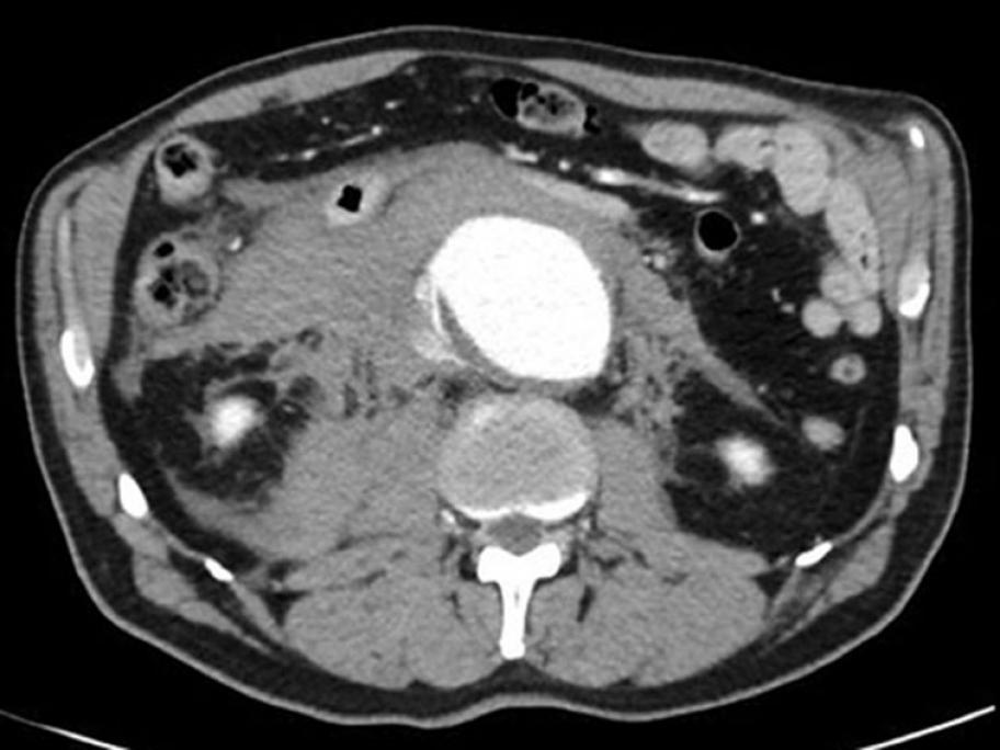 Axial ct abdominal aortic aneurysm