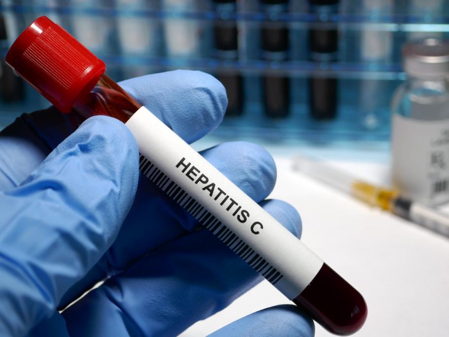 Hepatitis C