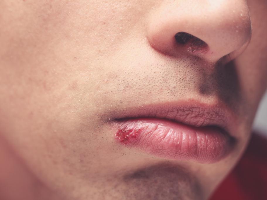 Cold sore