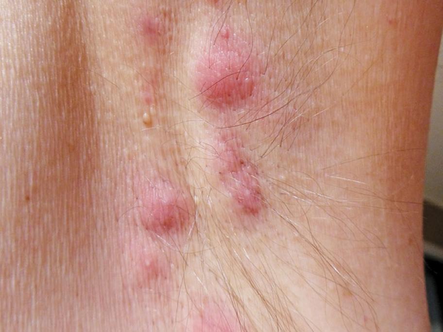 Hidradenitis suppurativa