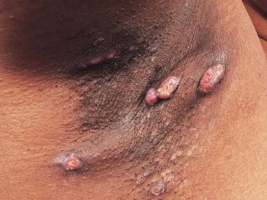 Hidradenitis