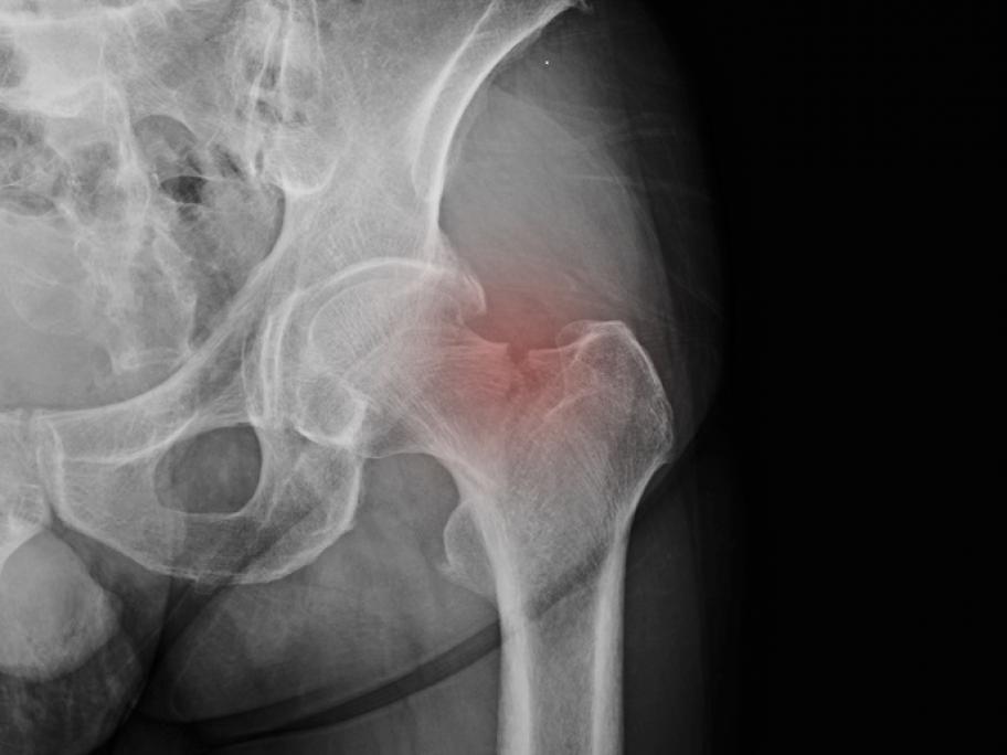 X-ray of hip fracture