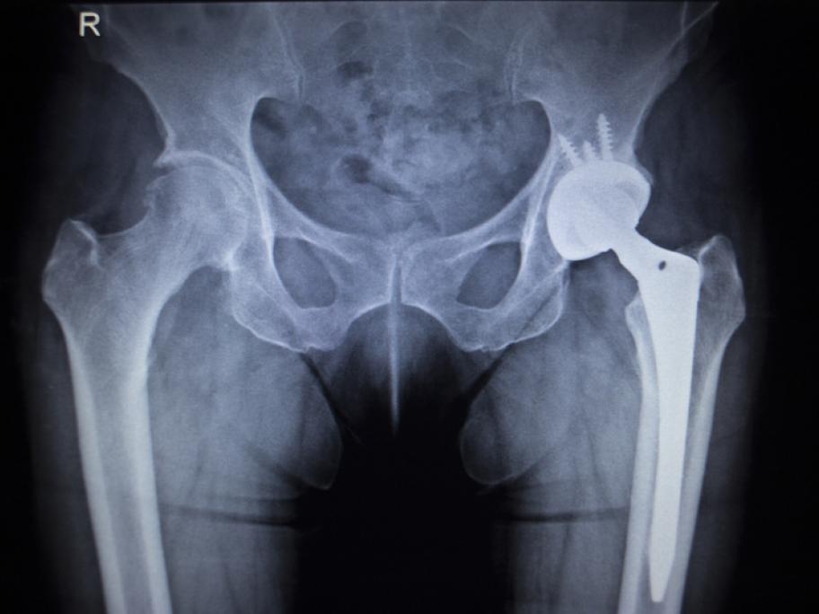 X-ray of pelvis with a hip replacement