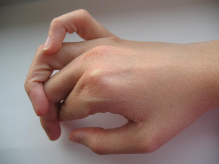 Hypermobility