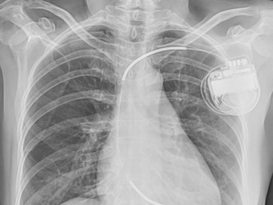 Chest X-ray showing ICD