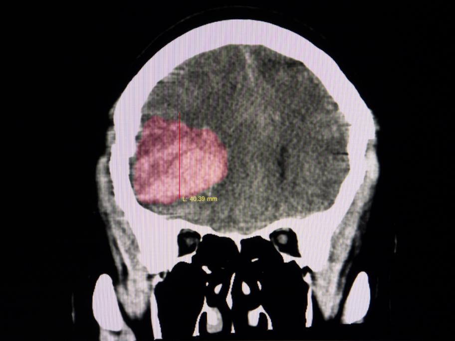 Haemorrhage