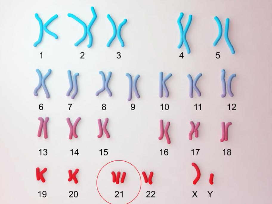 karyotype Down syndrome
