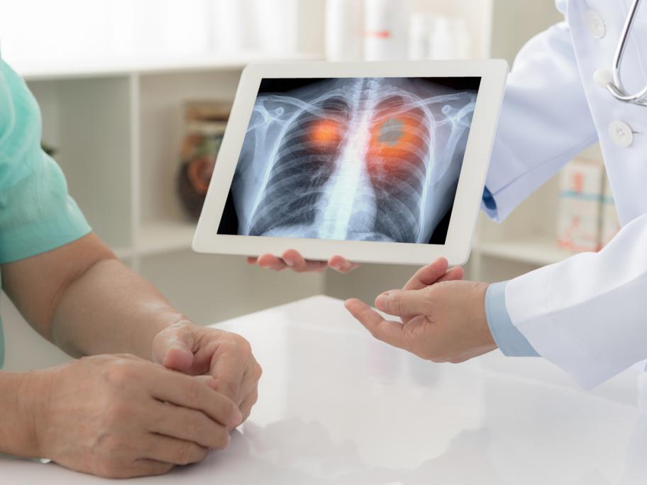 Lung cancer