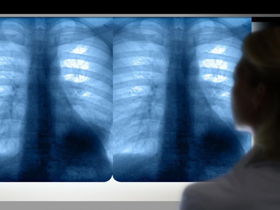 lung cancer