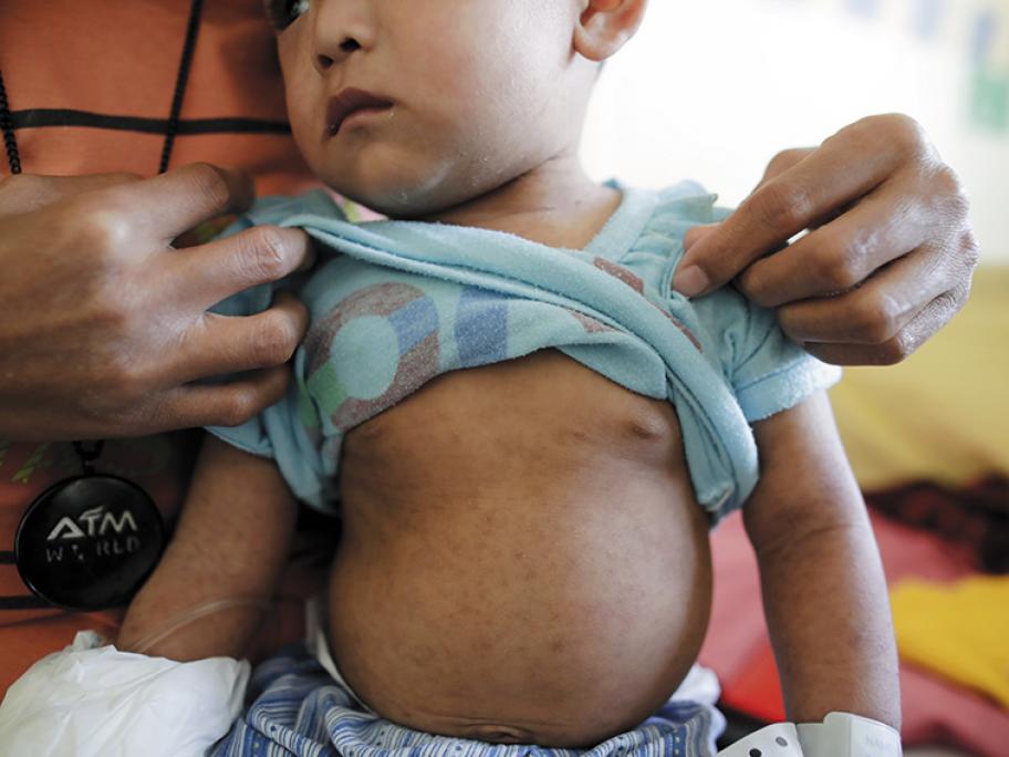 measles