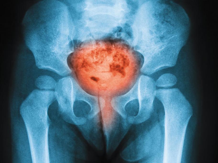 Pelvic pain
