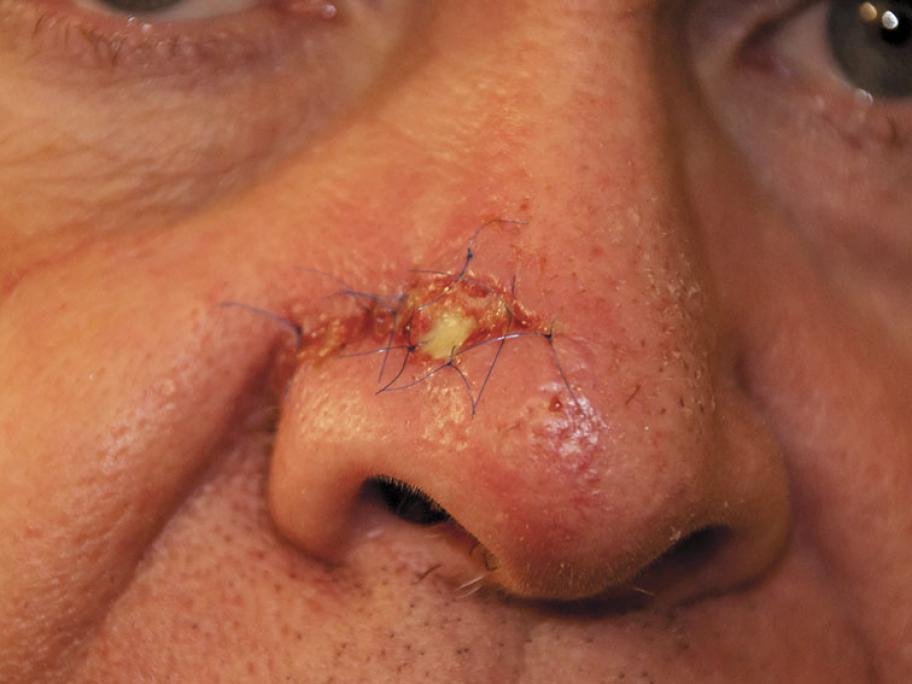 Mohs surgery