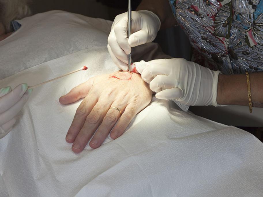Mohs surgery on a lesion on the hand