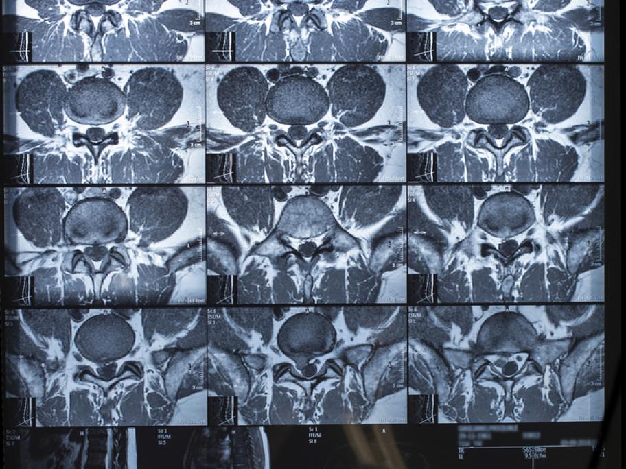 MRI scans lumbar spine
