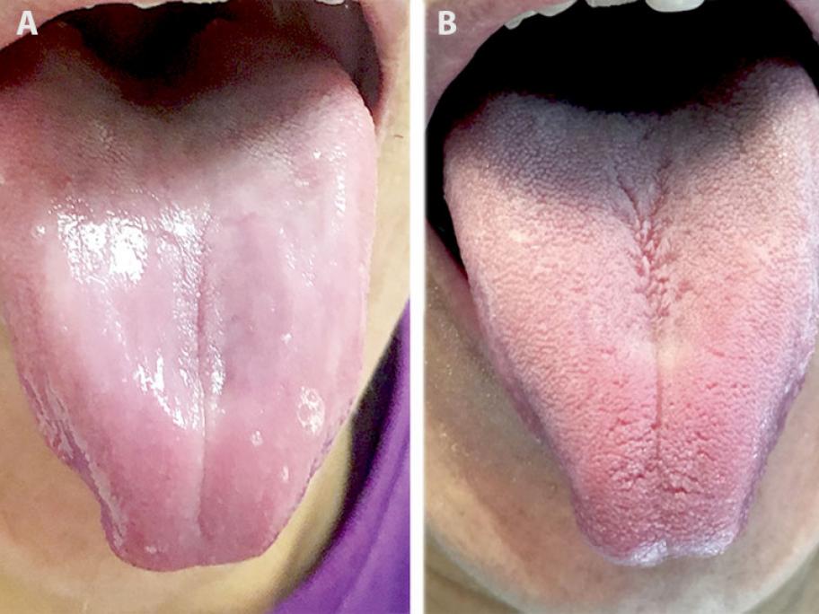 Tongue