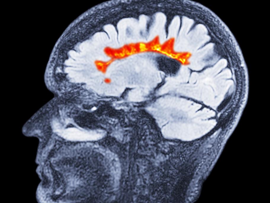 MRI scan